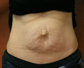 Feel Beautiful - Tummy Tuck Scar - Before Photo